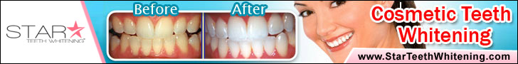 Star Teeth Whitening Results