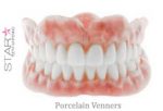 Porcelain Veneers