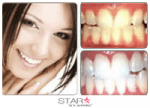 35% Star Teeth Whitening™ Gel