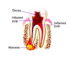 root-canal-therapy