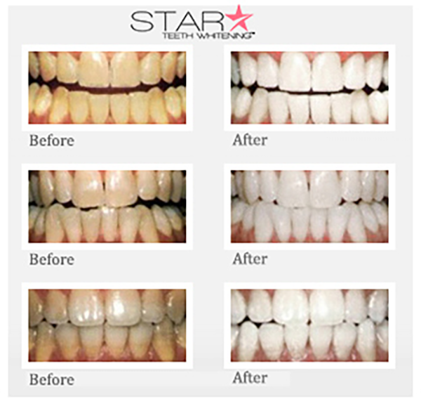 At-Home Star Teeth Whitening™ Treatments